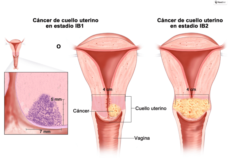 cancer-cérvicouterino.alt