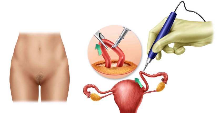 métodos-anticonceptivos-permanentes-alt
