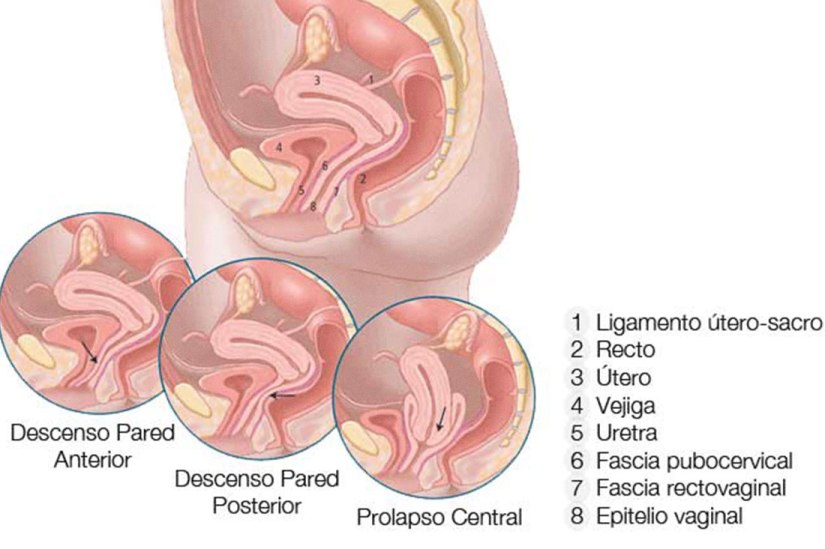 prolapso-genital