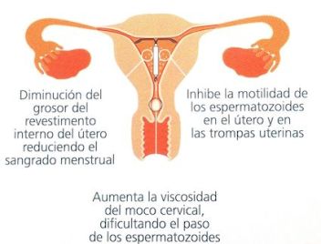 Ventajas de usar Mirena