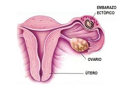 ¿Qué es un embarazo ectópico y sus síntomas? 