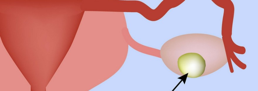 ¿te detectaron quiste en el ovario?