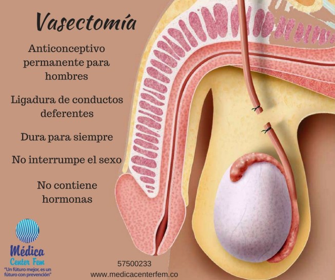 vasectomia