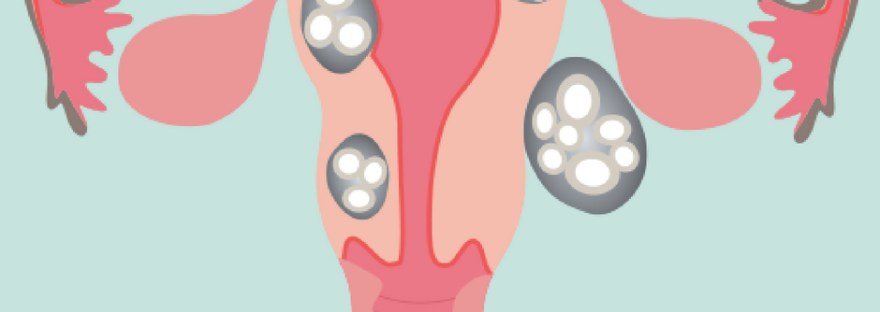 miomatosis uterina