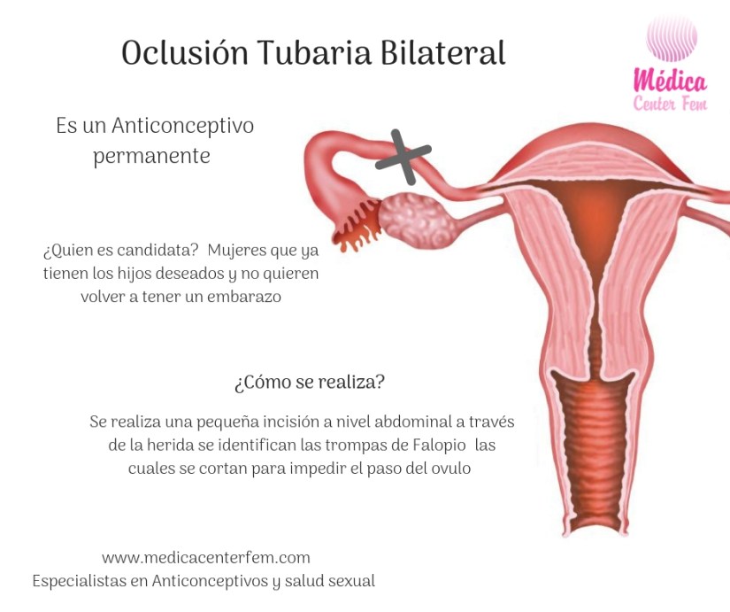 oclusión tubaria bilateral