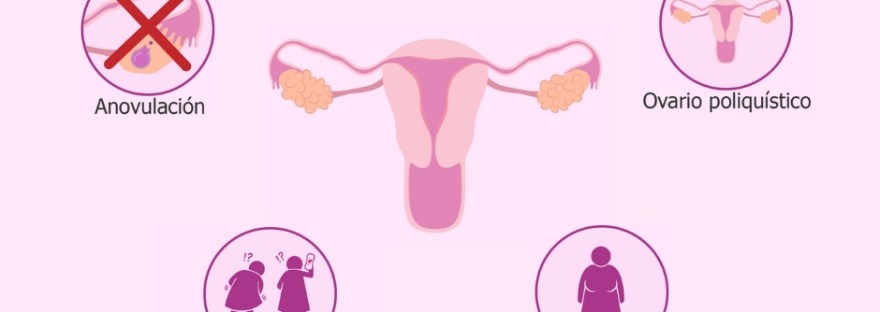ovario poliquístico